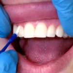 fluorizacija zuba