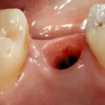 Alveolitis nakon vađenja zuba