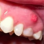 fistula na desnima