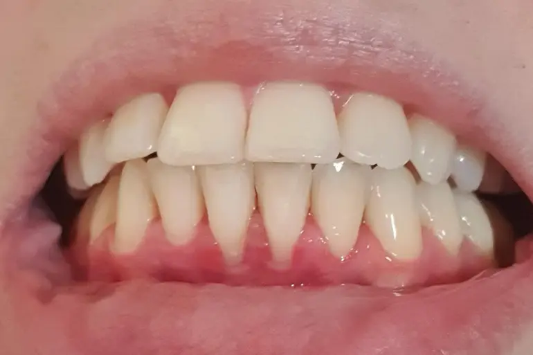 Kako vratiti povučene desni