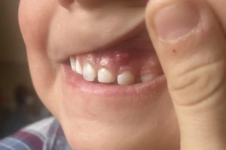 Apsces zuba kod dece