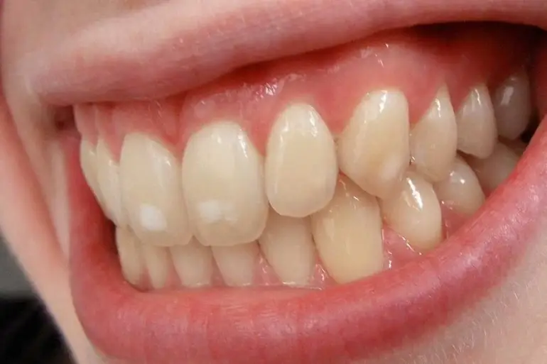 bele fleke na zubima